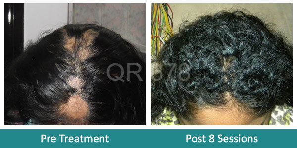 Best Alopecia Areata Treatment, Cost in Mumbai, India