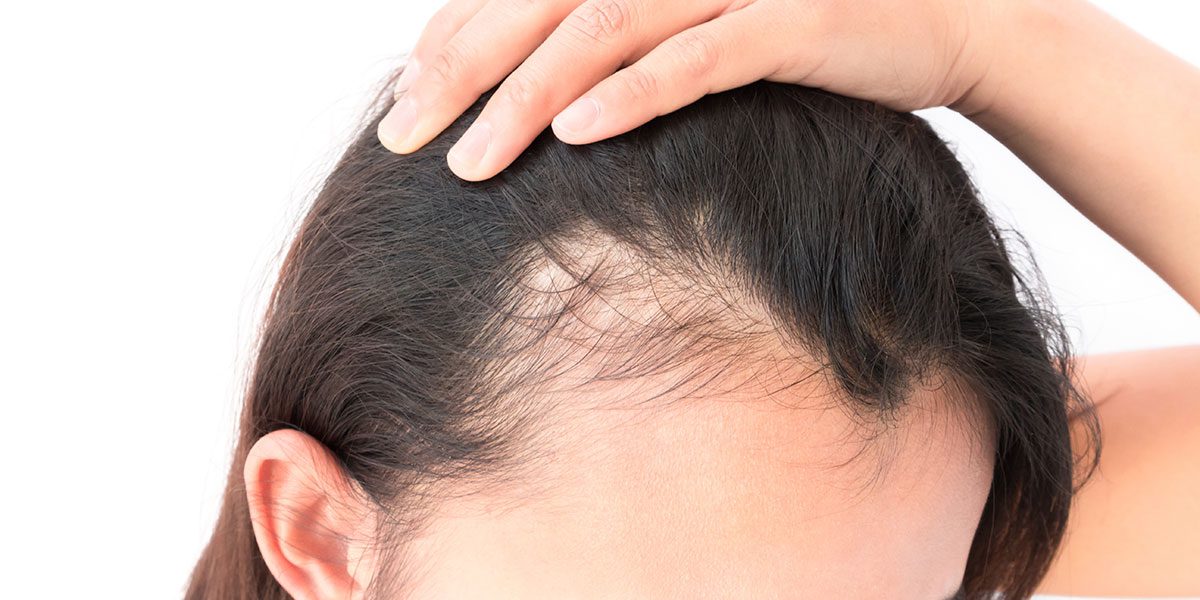 Androgenetic Alopecia Treatment, Cost in Mumbai, India – QR678