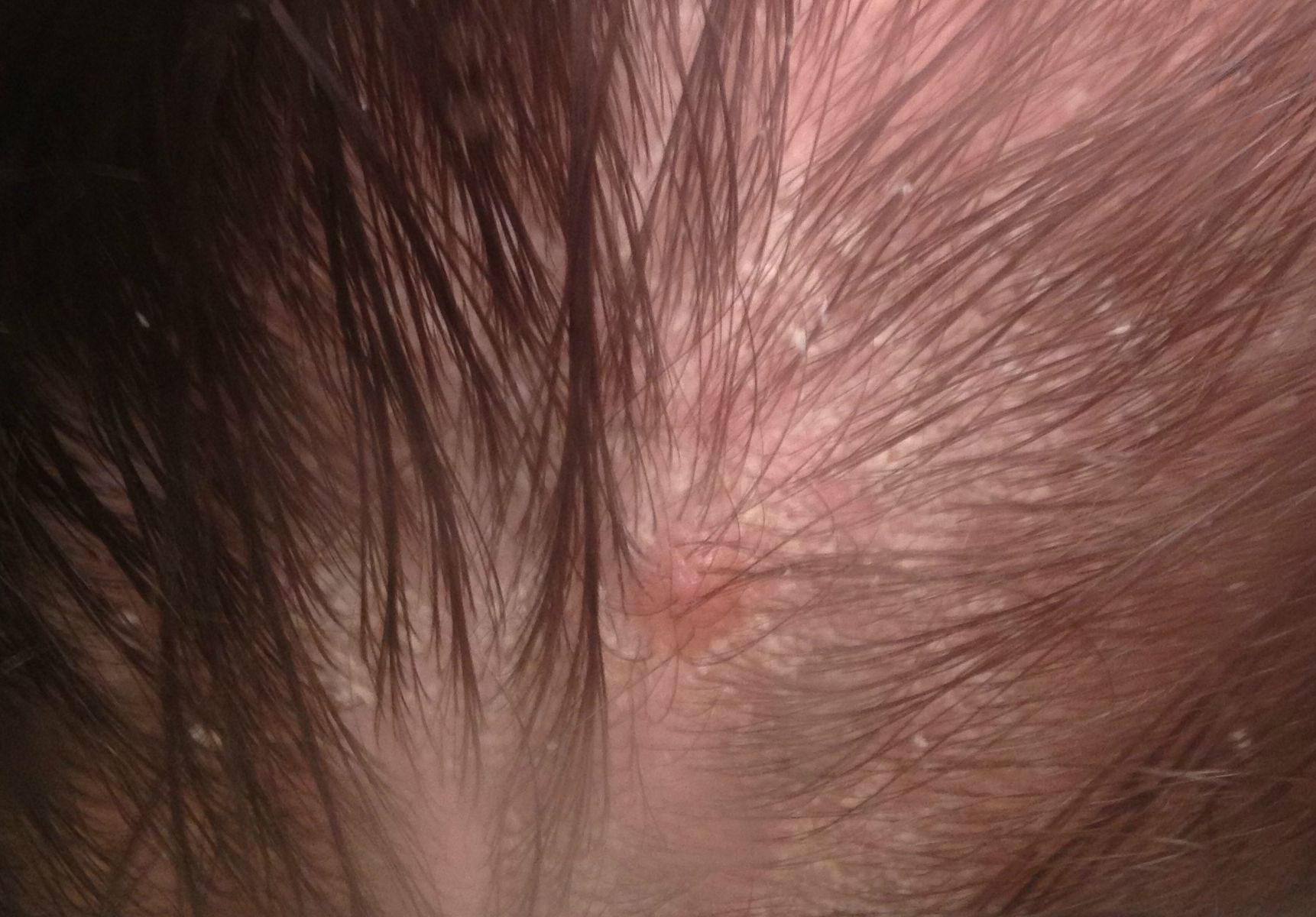 Seborrheic Dermatitis Scalp Dandruff treatment for men and women,cost in mumbai, india