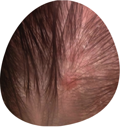 Scalp Eczema  Signs Causes Prevention And Treatments  SkinKraft