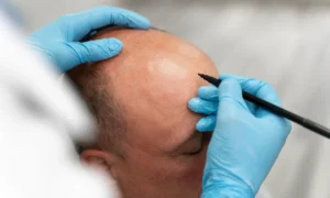 How to Evaluate Hair Loss Clinics in India for a Truly Effective Result