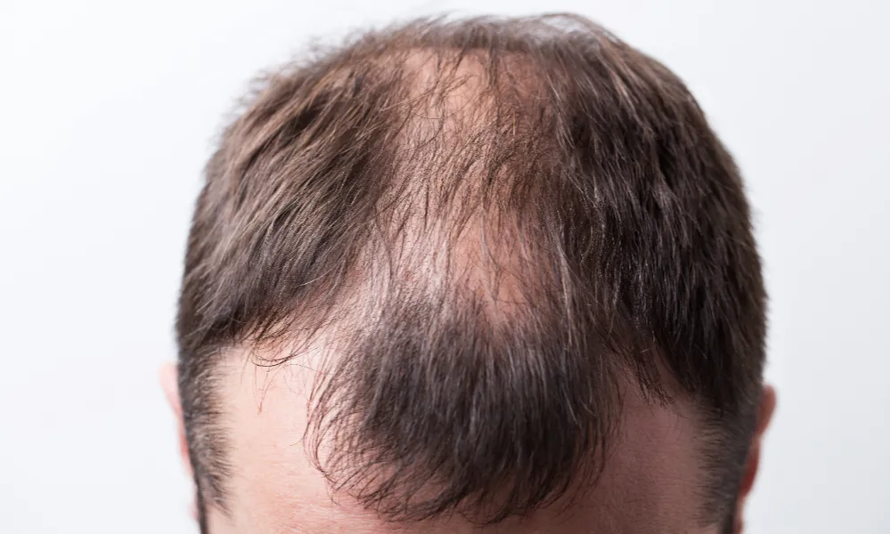 Hair Fall and Hair Growth Treatment for Men